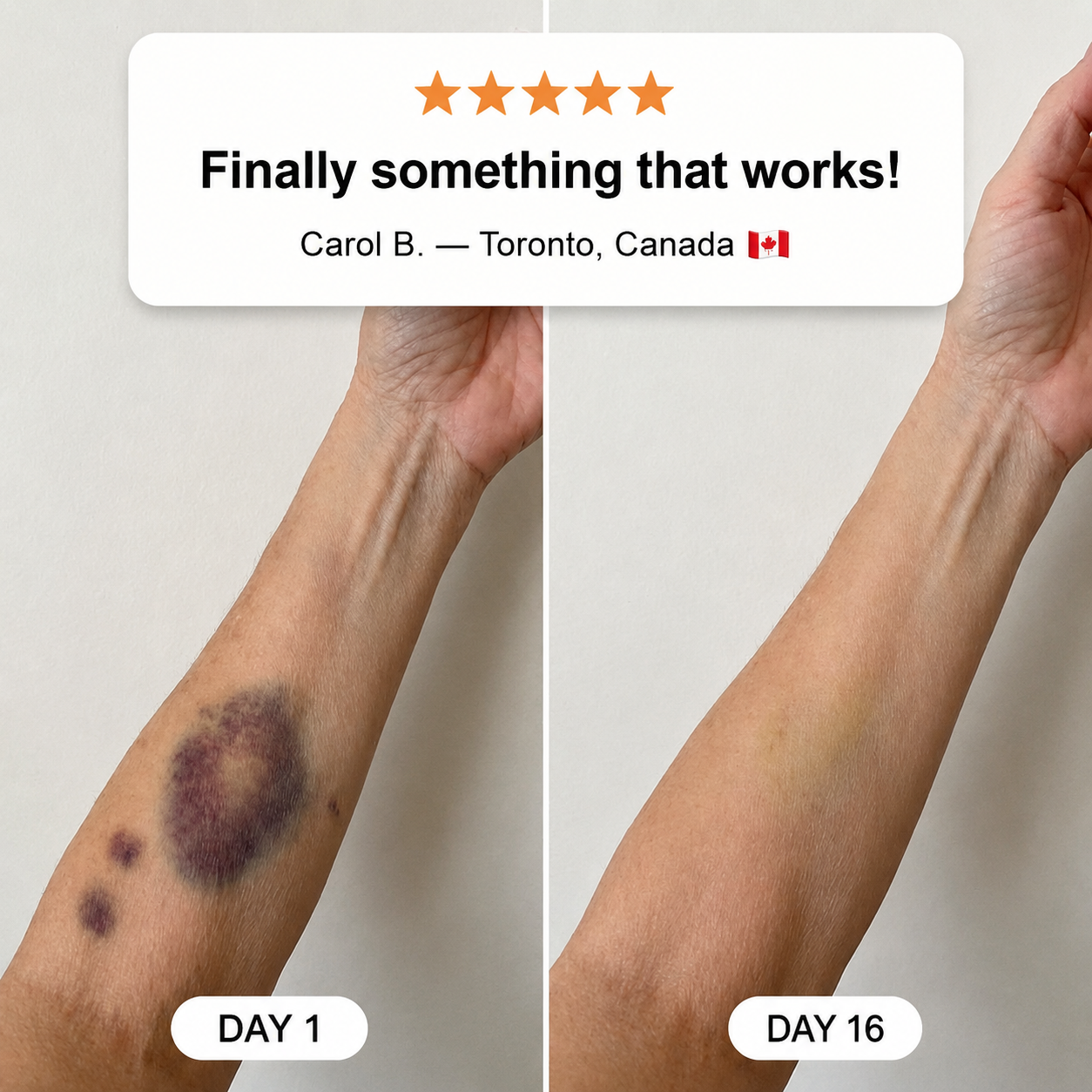 💥100K+ SOLD💕- 𝐏𝐮𝐫𝐞𝐥𝐨𝐫𝐚® Bruise Repair & Skin-Strengthening Cream