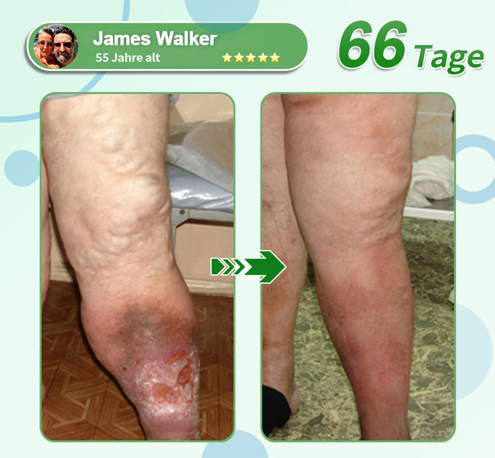 [Siehe Ergebnisse in 7 Tagen]🔔 SMGT-GLP-1 Nano Microneedle Patch & Matrixyl 3000 (Schmerzfrei, langanhaltend, behandelt Diabetes, Fettleibigkeit und Herz-Kreislauf-Erkrankungen)