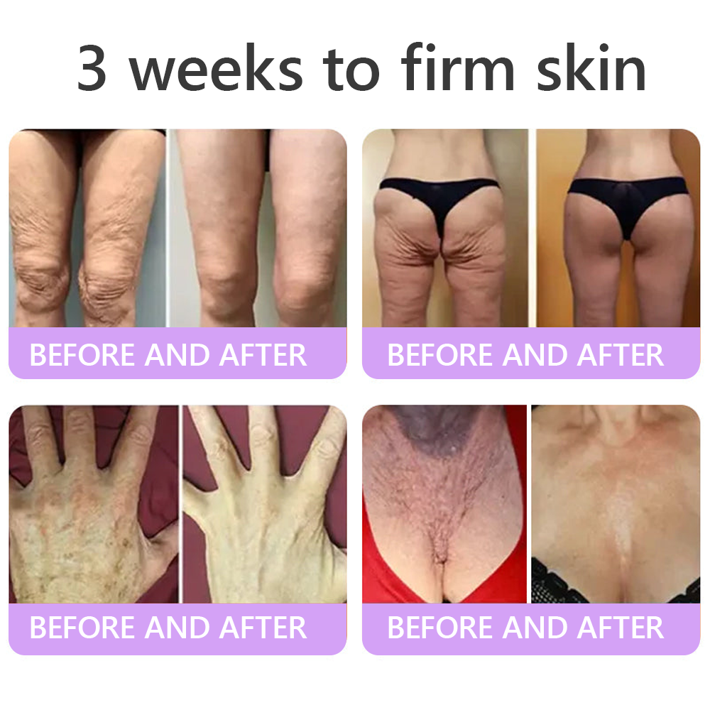 𝐏𝐮𝐫𝐞𝐥𝐨𝐫𝐚® ❤️PDRN Multi-Peptide Massaging Body Roller Cream- Anti-aging, Hydrating, Skin Firming & Lifting, Skin Repair, Even Tone, Acne and Dark Spot Treatment, Wart and Mole Removal, and Psoriasis Relief.