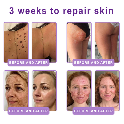 𝐏𝐮𝐫𝐞𝐥𝐨𝐫𝐚® ❤️PDRN Multi-Peptide Massaging Body Roller Cream- Anti-aging, Hydrating, Skin Firming & Lifting, Skin Repair, Even Tone, Acne and Dark Spot Treatment, Wart and Mole Removal, and Psoriasis Relief.