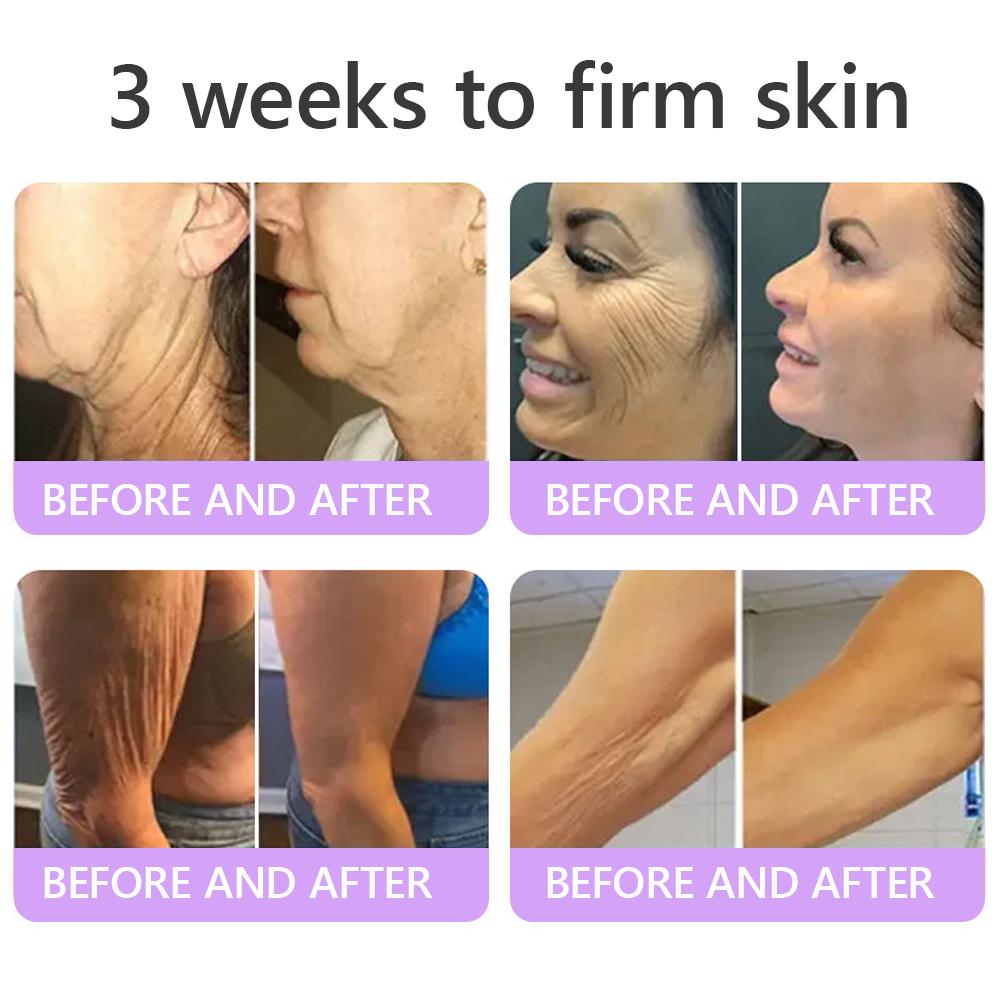 𝐏𝐮𝐫𝐞𝐥𝐨𝐫𝐚® ❤️PDRN Multi-Peptide Massaging Body Roller Cream- Anti-aging, Hydrating, Skin Firming & Lifting, Skin Repair, Even Tone, Acne and Dark Spot Treatment, Wart and Mole Removal, and Psoriasis Relief.